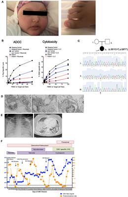 Novel Heterozygous Mutation in NFKB2 Is Associated With Early Onset CVID and a Functional Defect in NK Cells Complicated by Disseminated CMV Infection and Severe Nephrotic Syndrome